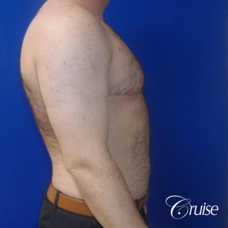 Severe Gynecomastia- Free nipple Graft - After Image 2