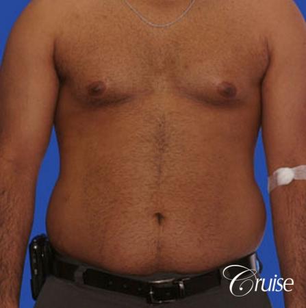 best liposuction abdomen and flanks on a male patient - Before Image