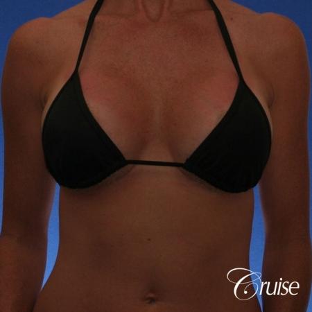 Best breast revision for low implants - After Image 4