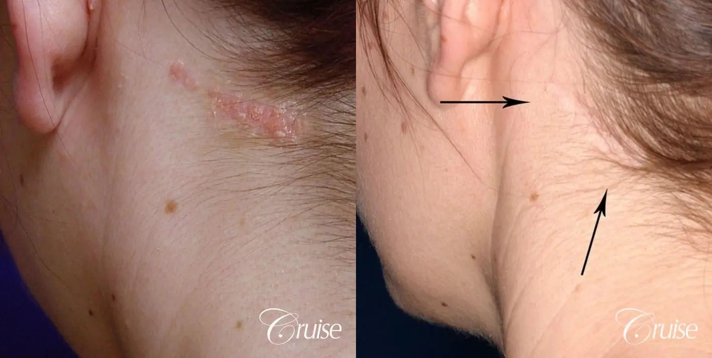 best birth mark removal scar revision - Before and After 1