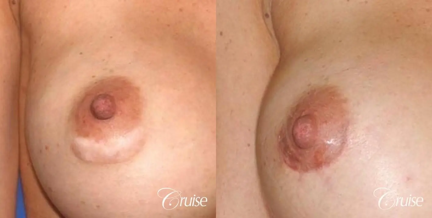 best areola scar revision after breast augmentation - Before and After 1