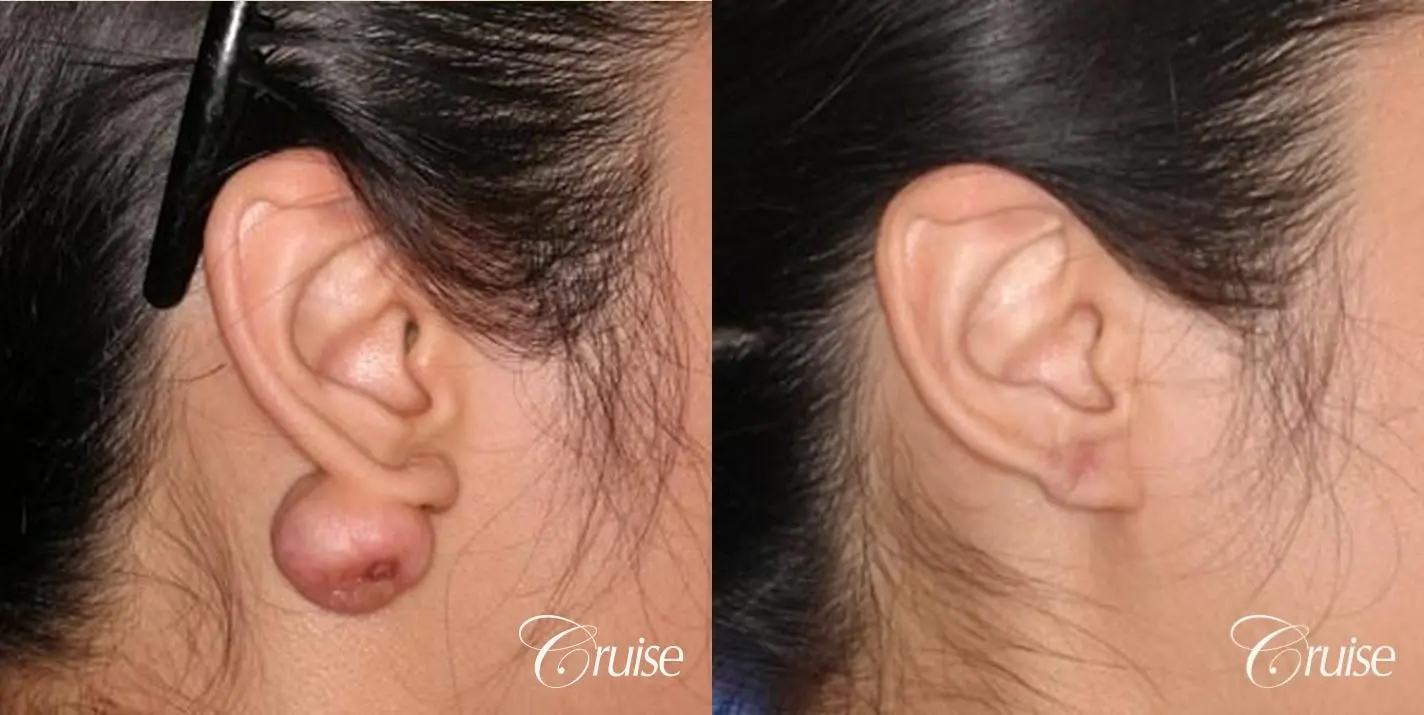 best keloid removal and treatment on ear pictures - Before and After 1