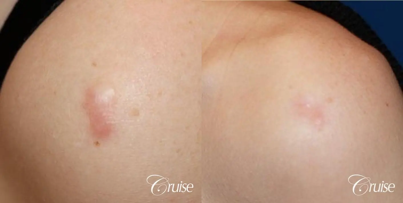best results for kenalog injection on keloid - Before and After