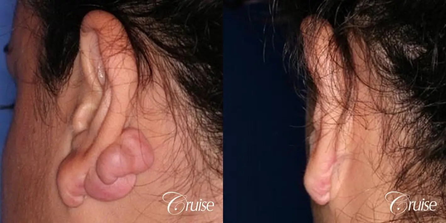best photos of keloid removal in Newport Beach - Before and After