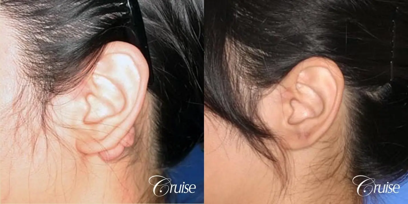 best keloid removal and treatment on ear pictures - Before and After 2