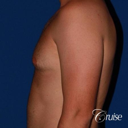 best puffy nipple surgery correction - Before Image 2
