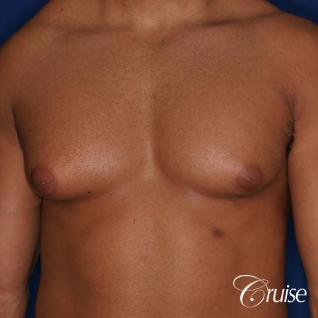 26 yo athletic patient with moderate gynecomastia - Before Image 1