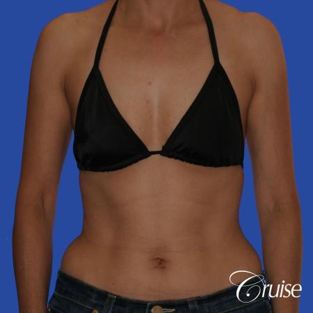 Breast Augmentation - Before and After Image 3