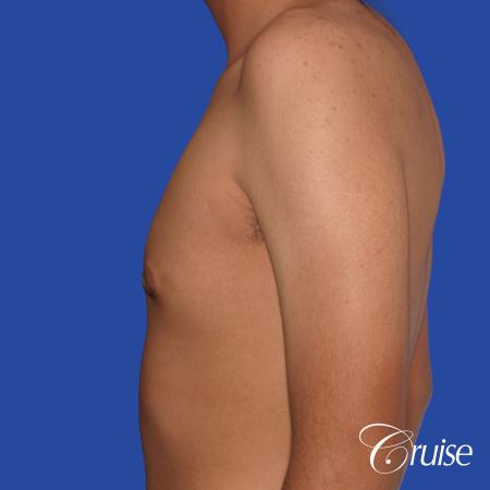 gynecomastia patient gets nipple reduction for best results - After Image 2