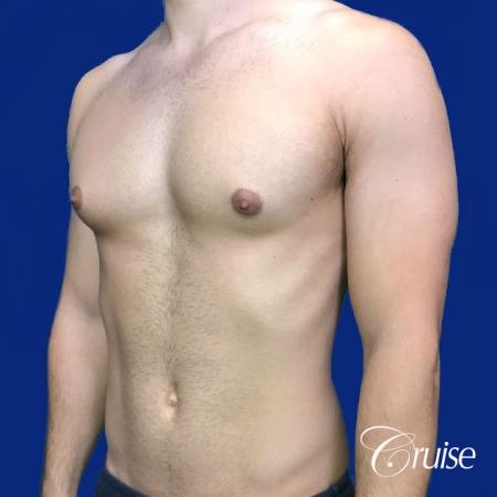 gynecomastia correction newport beach - Before and After 3