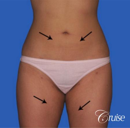 best before and after liposuction stomach and love handles - After Image 1