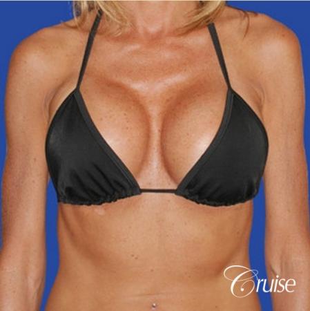 breast lift on one side only before and after pictures - After Image 4