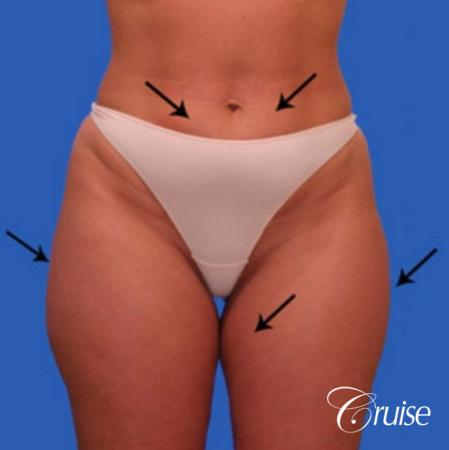 best liposuction abdomen flanks medial and lateral thighs dramatic - Before Image