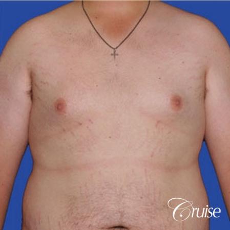 weight loss patient with gynecomastia - Before Image 1
