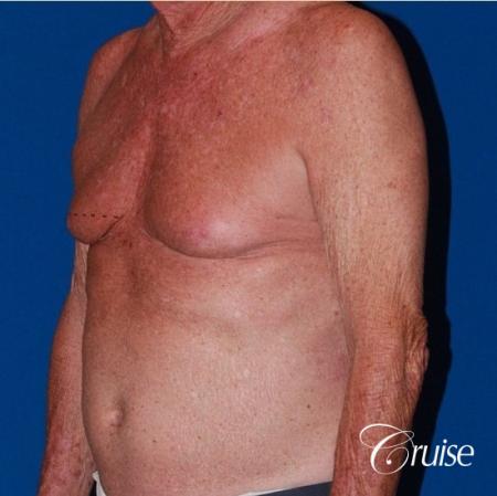 free nipple graft gynecomastia on old man - Before Image 2