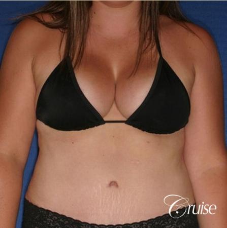 best results on young woman for breast lift anchor with saline augmentation - After Image 5