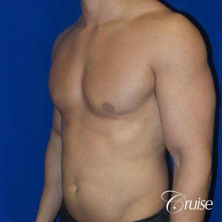 Best before and after gynecomastia pictures - After Image 2