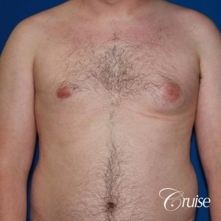 asymmetric gynecomastia moderate - Before Image 1
