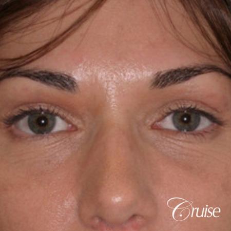 best soft tissue filler using Juvaderm - After Image 1