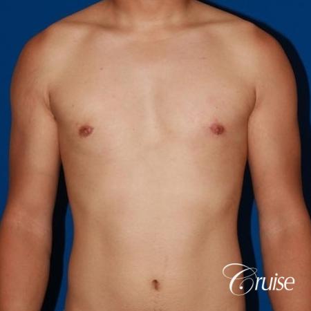 young athletic adult with puffy nipple - After Image 1