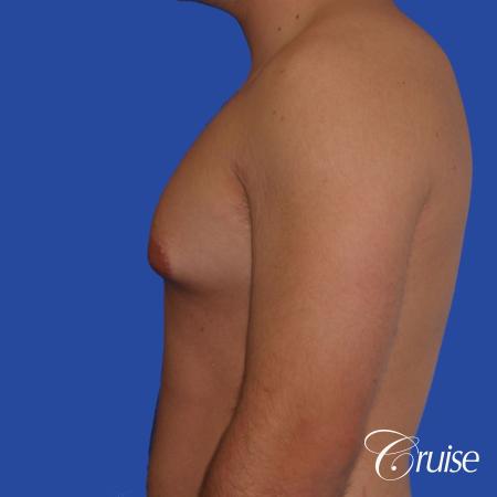 mild case of gynecomastia on adult - Before Image 2