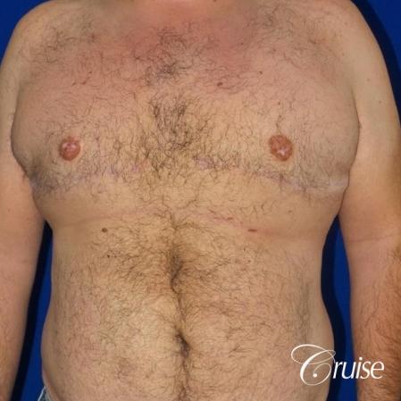 Severe Gynecomastia -Free Nipple Graft - After Image 1