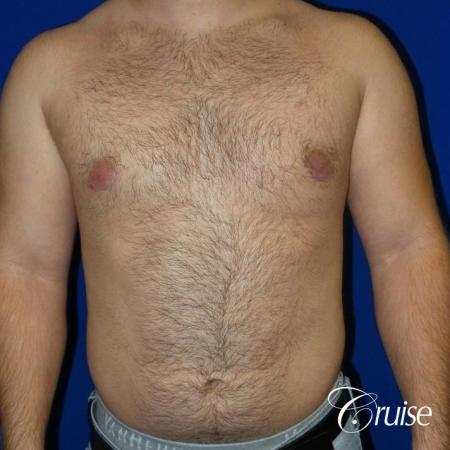 best gynecomastia results - After Image 1
