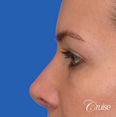 best before and after pictures of upper eyelid surgery - After Image 2