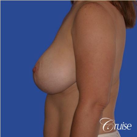 best revision to correct large breast - Before and After Image 2