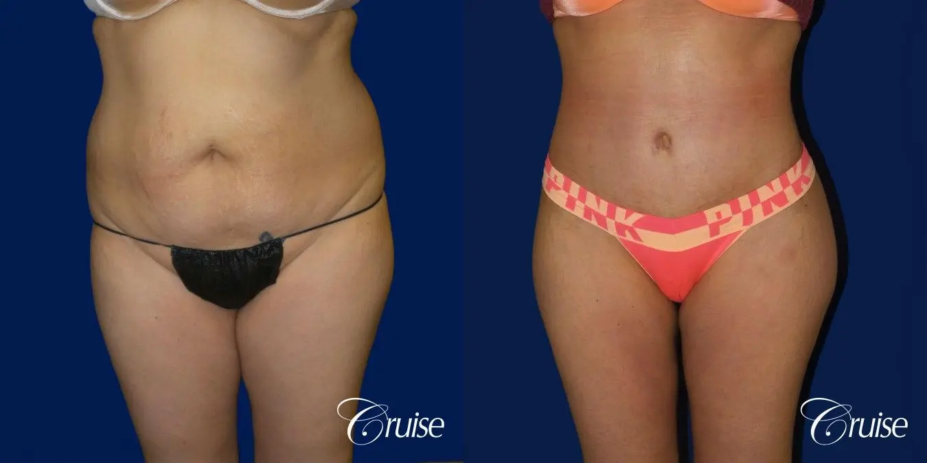 Tummy Tuck Extended Incision - Before and After  