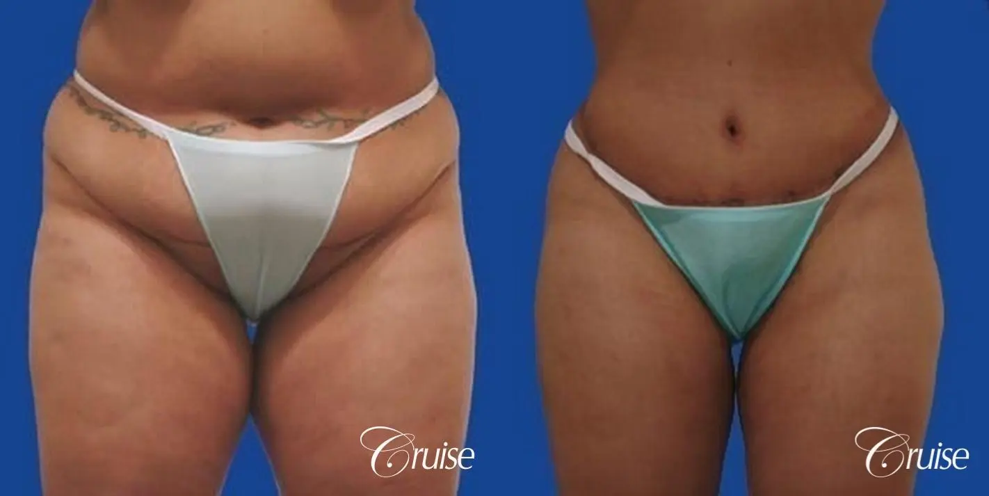 best extended incision tummy tuck scar - Before and After 1