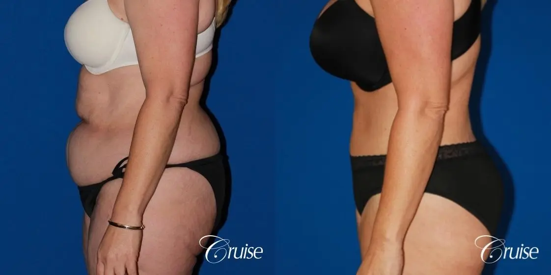 Tummy Tuck: Patient 23 - Before and After 2