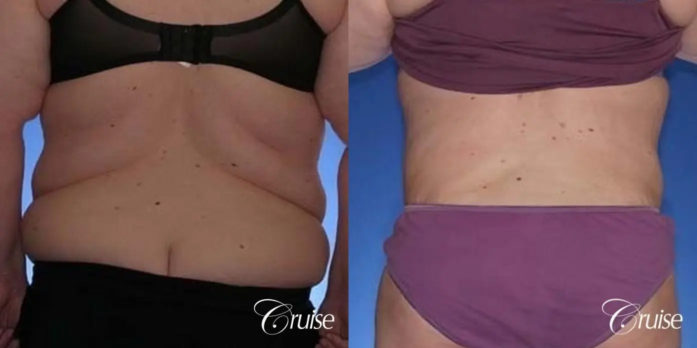 best before and after pictures of extended tummy tuck scar - Before and After 4