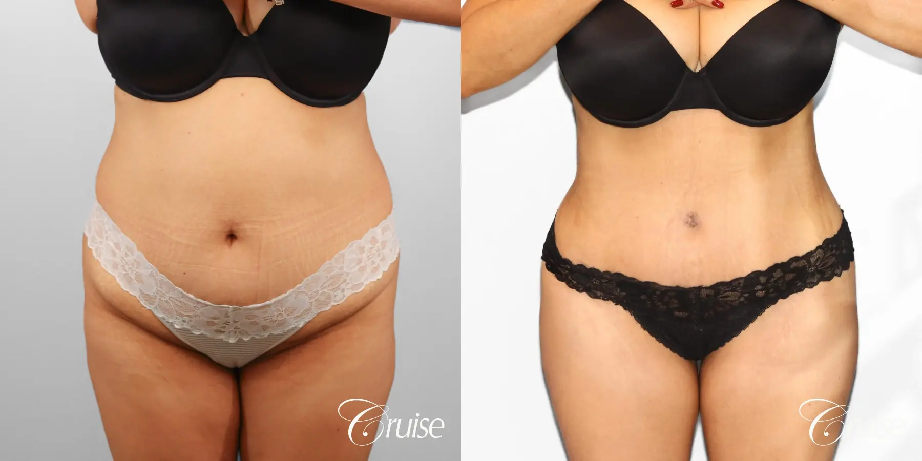 Tummy Tuck: Patient 78 - Before and After 1
