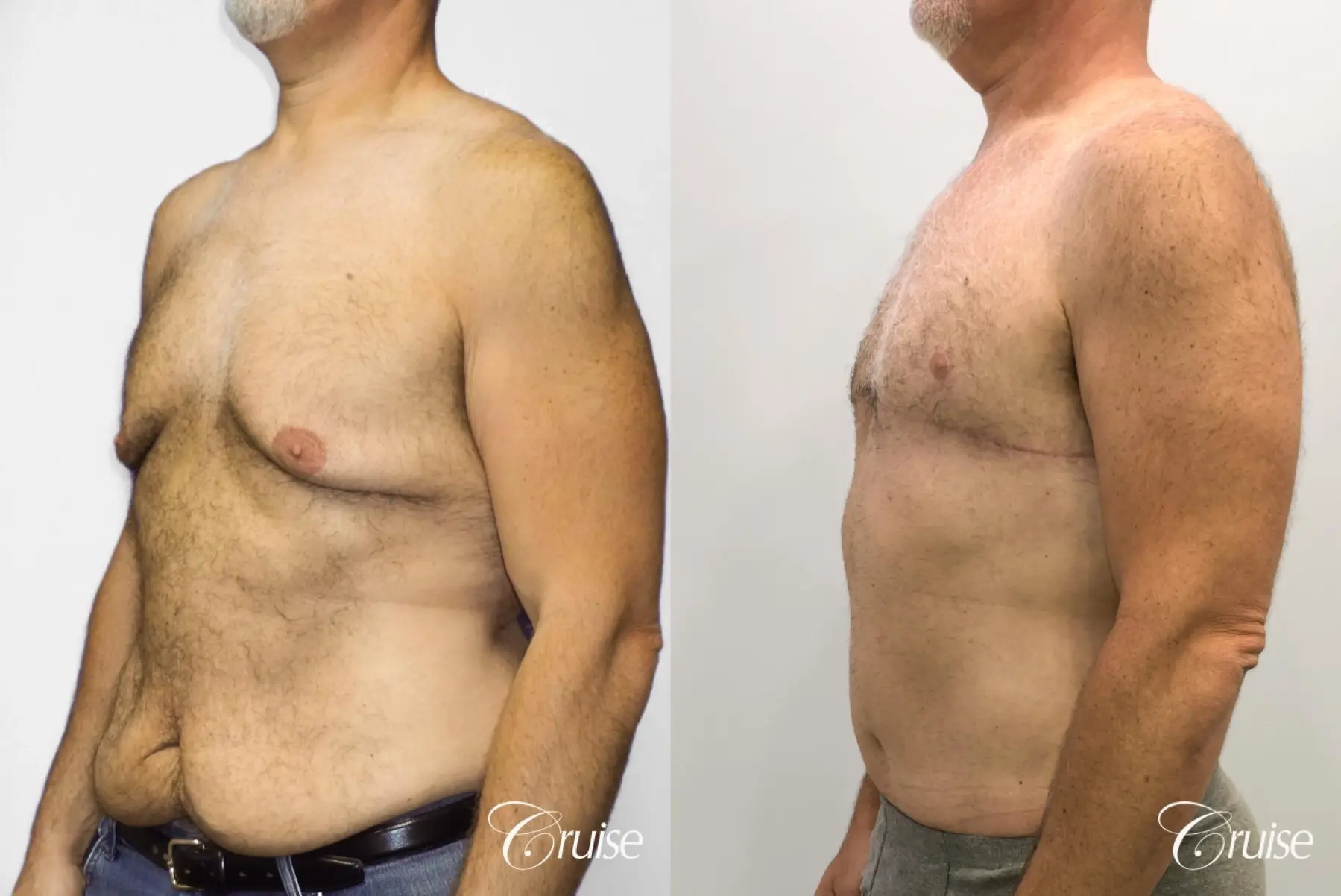 Tummy Tuck: Patient 77 - Before and After 4