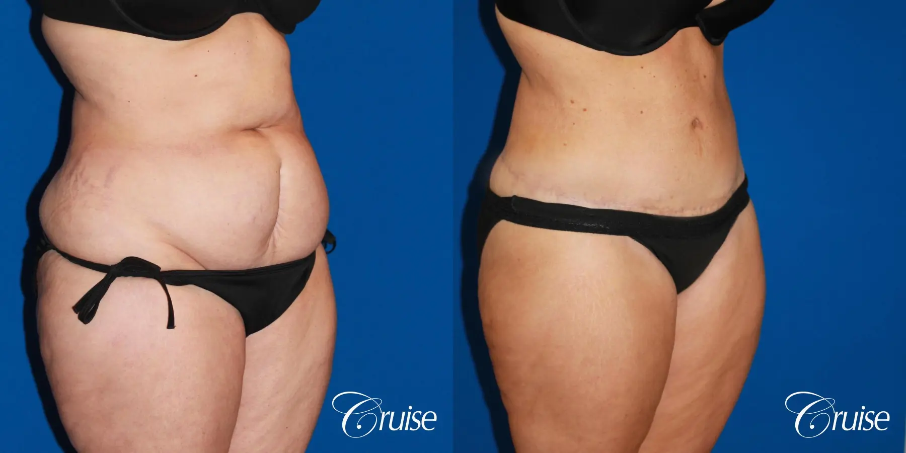 Tummy Tuck: Patient 86 - Before and After 2