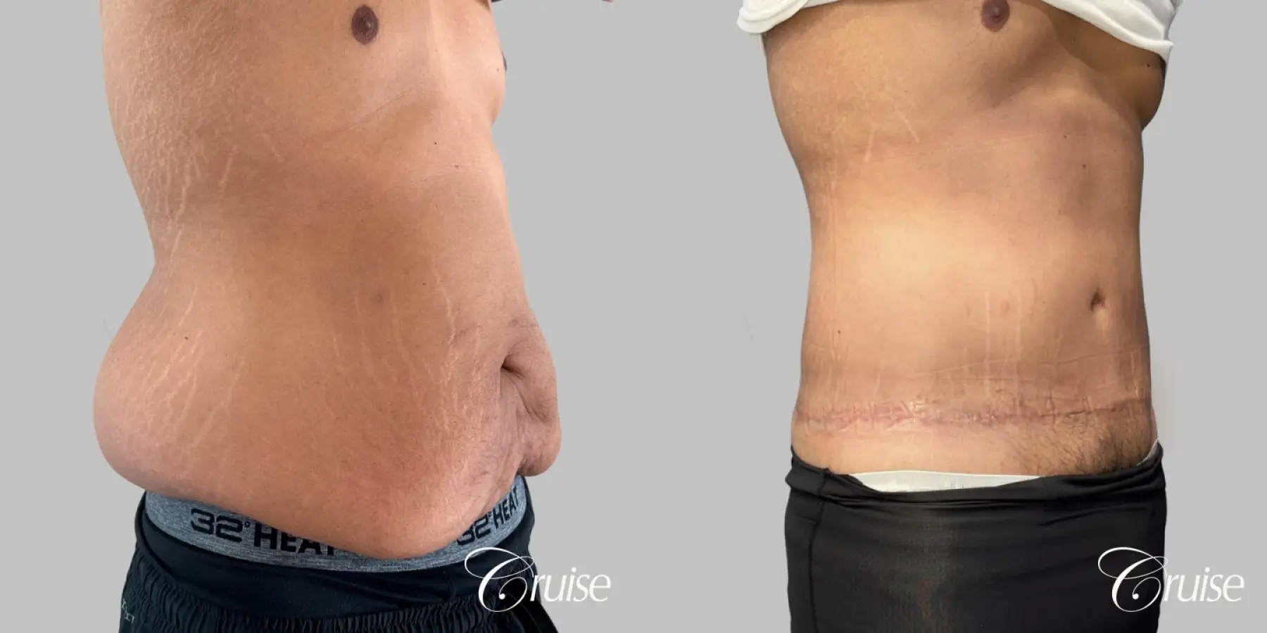 Male Tummy Tuck - Circumferential - Before and After 2