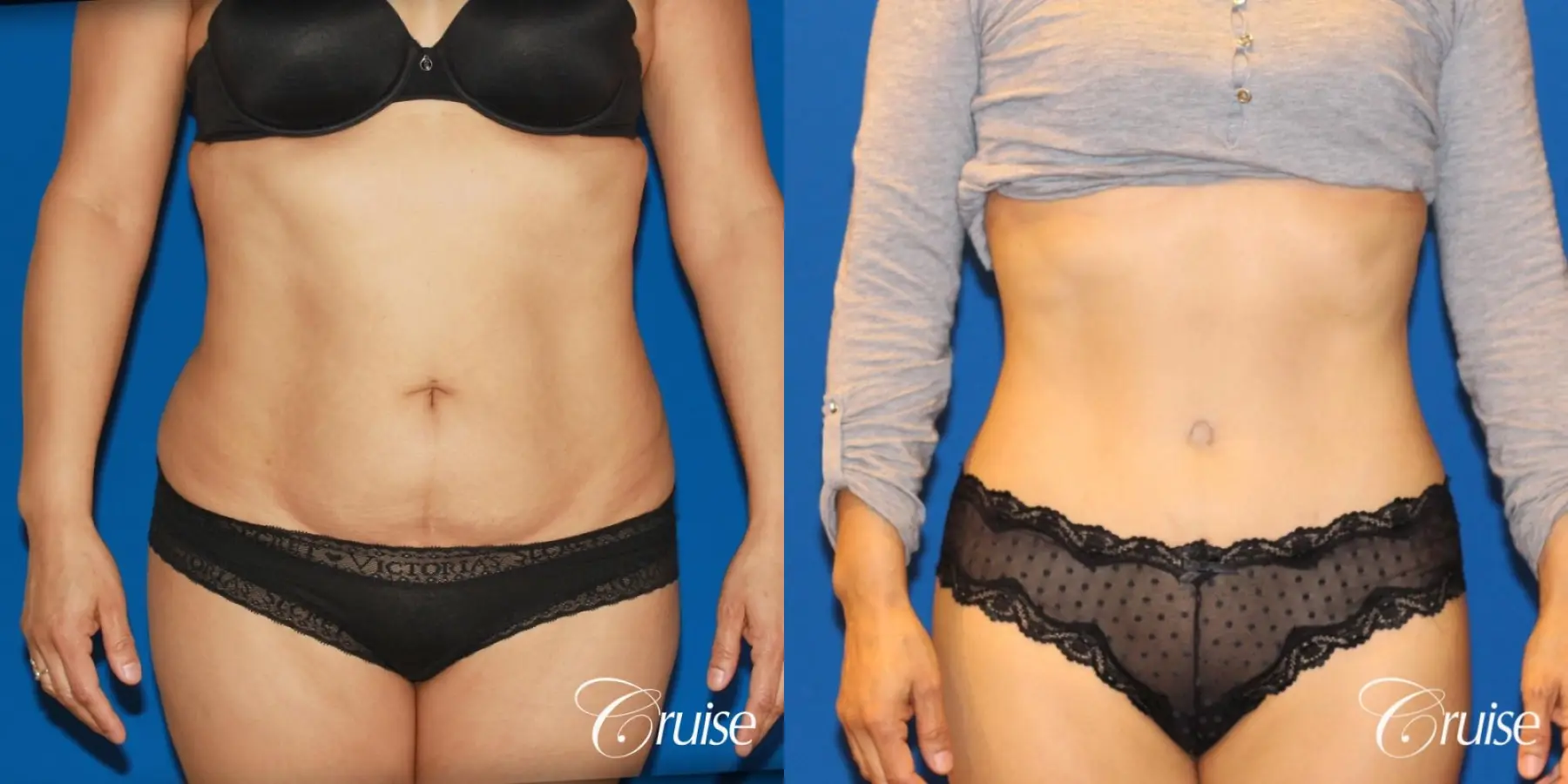 Tummy Tuck: Patient 15 - Before and After 1