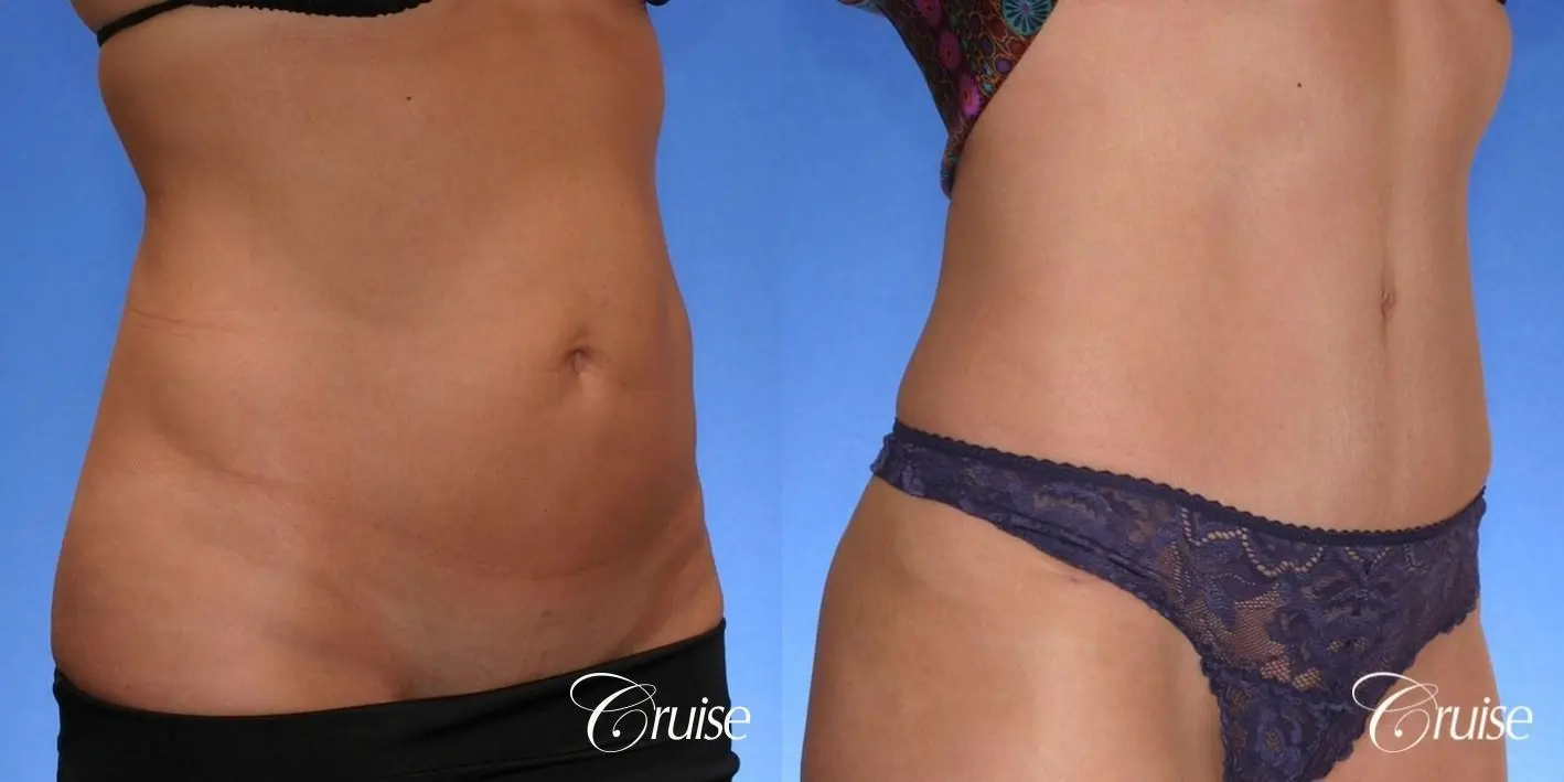 best scar on thin female tummy tuck patient - Before and After 3