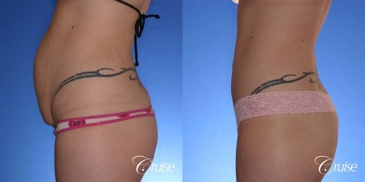 Tummy Tuck: Patient 44 - Before and After 2