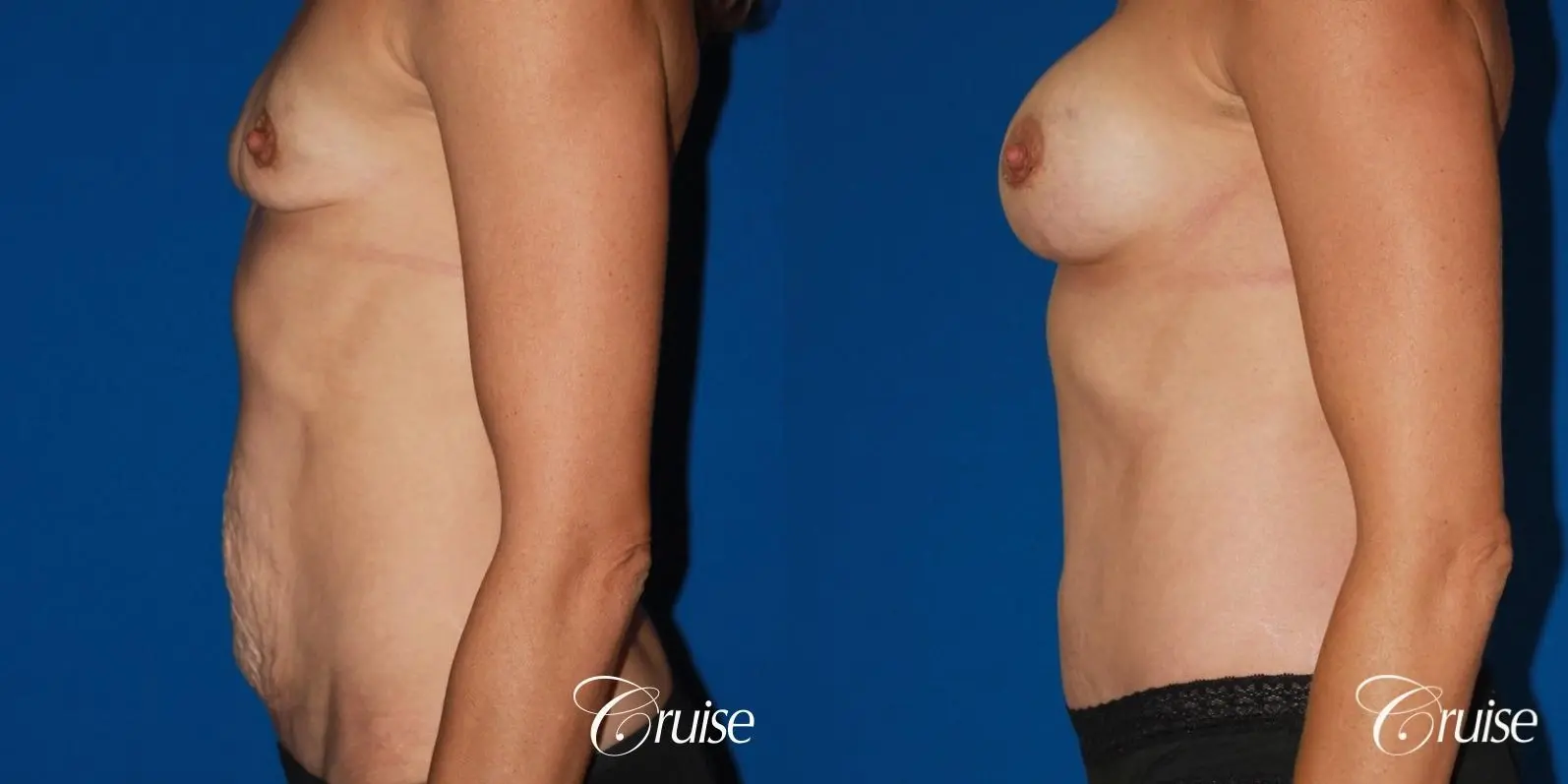 Tummy Tuck: Patient 25 - Before and After 2