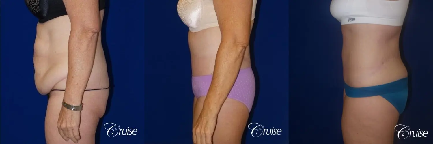 62 Yr Old Female Circumferential Tummy Tuck w/BBL & Liposuction - Before and After 5