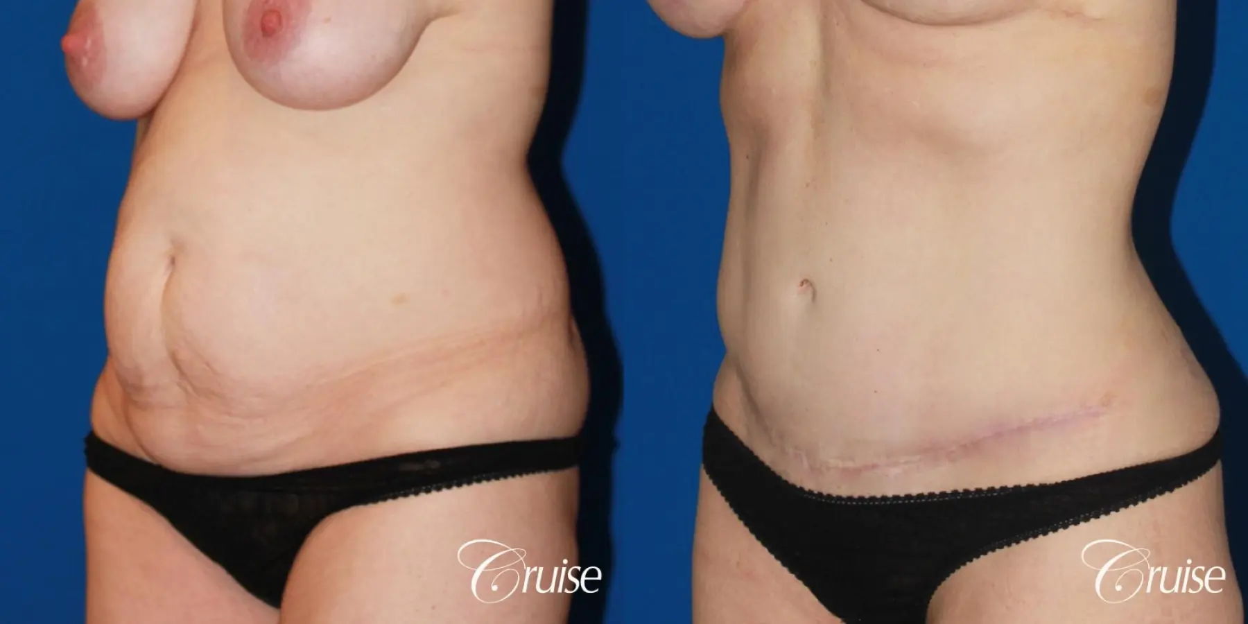 Tummy Tuck: Patient 25 - Before and After 3