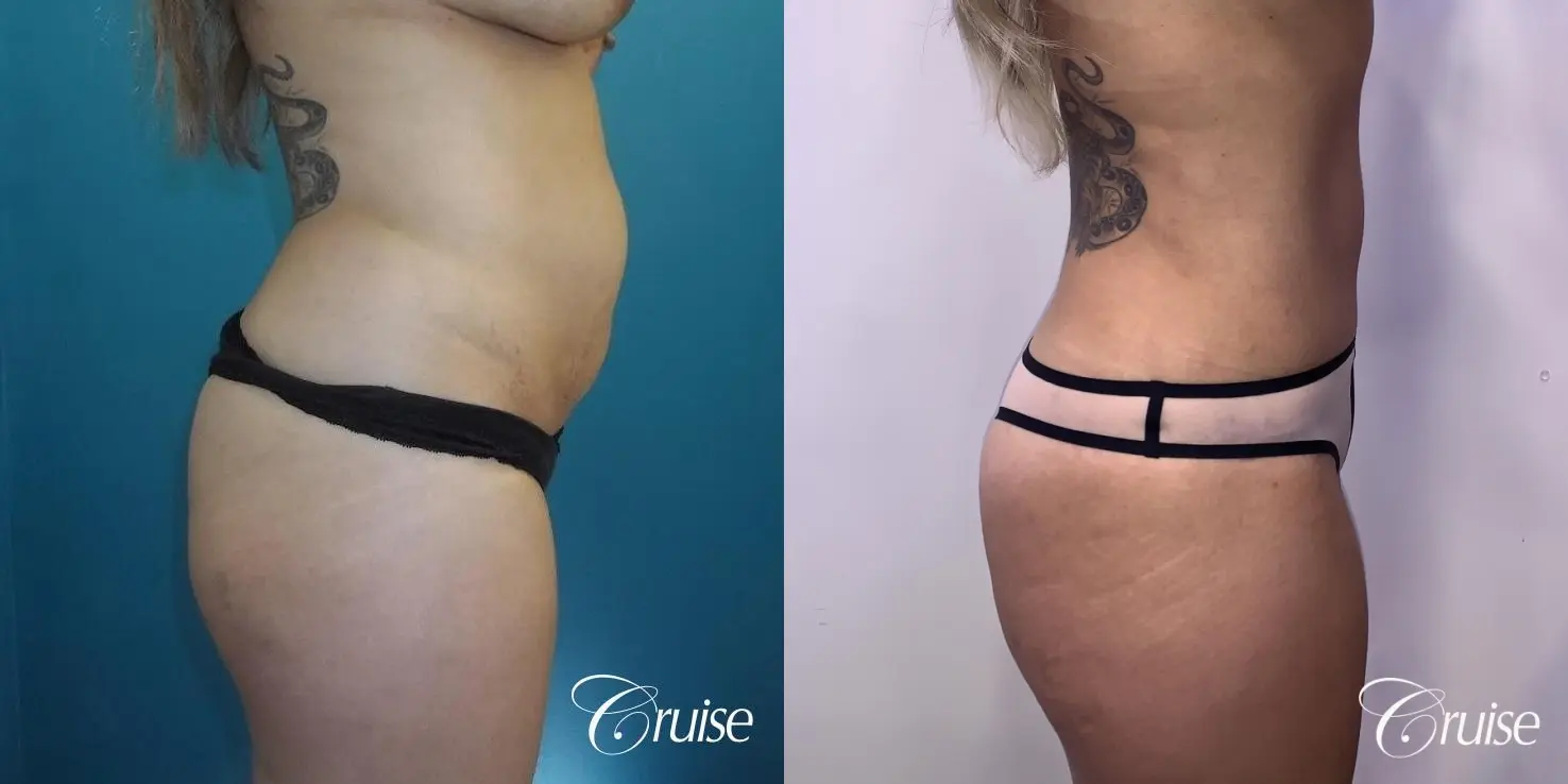 Standard Tummy Tuck, Liposuction with BBL, & Breast Implants: 36 Yr Old Mom - Before and After 4