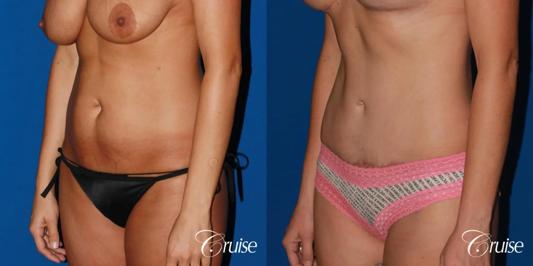 Standard Tummy Tuck & Liposuction: 35 Yr Old Female - Before and After 3