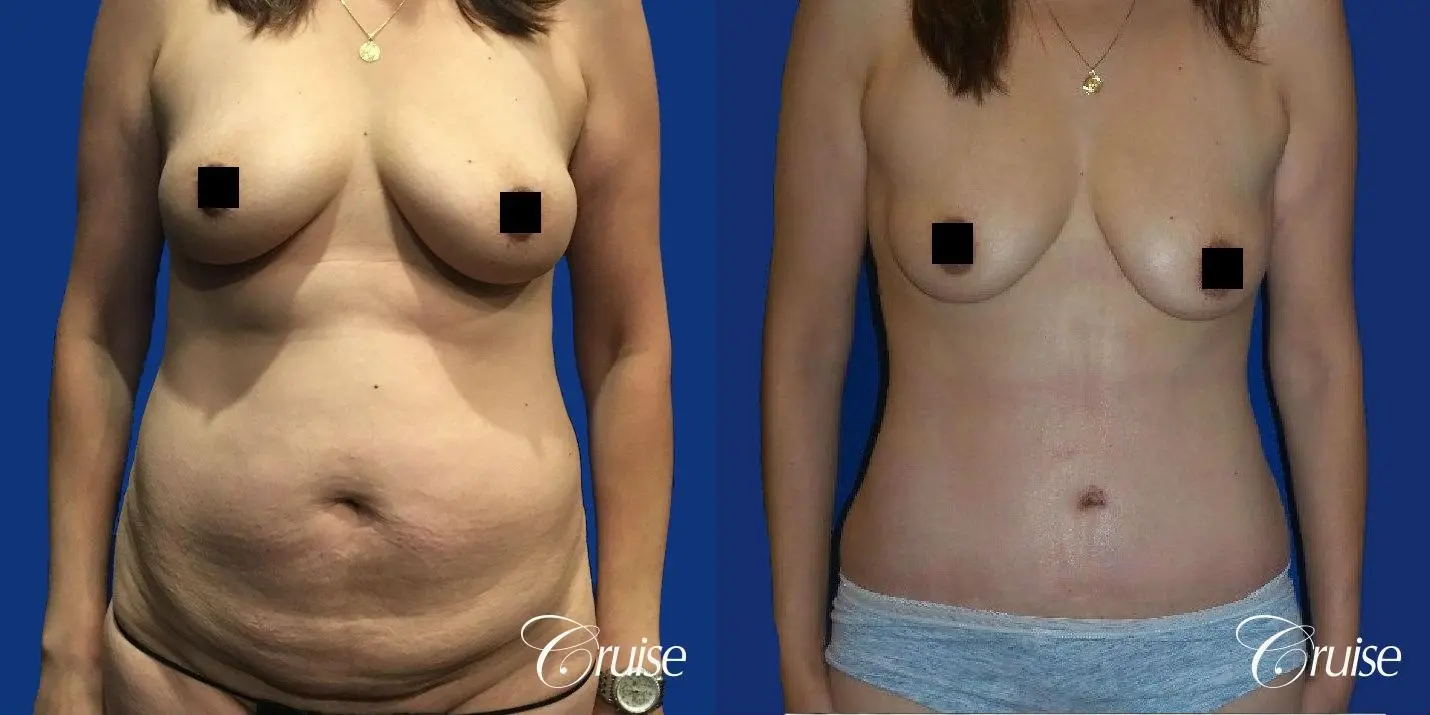 Best tummy tuck incisions orange county - Before and After