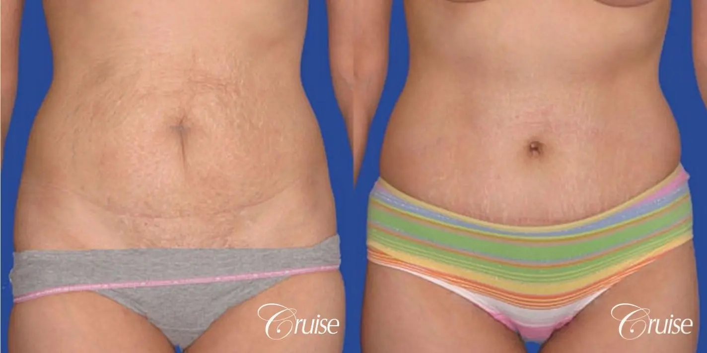 best tummy tuck super low scar plastic surgeon - Before and After 1