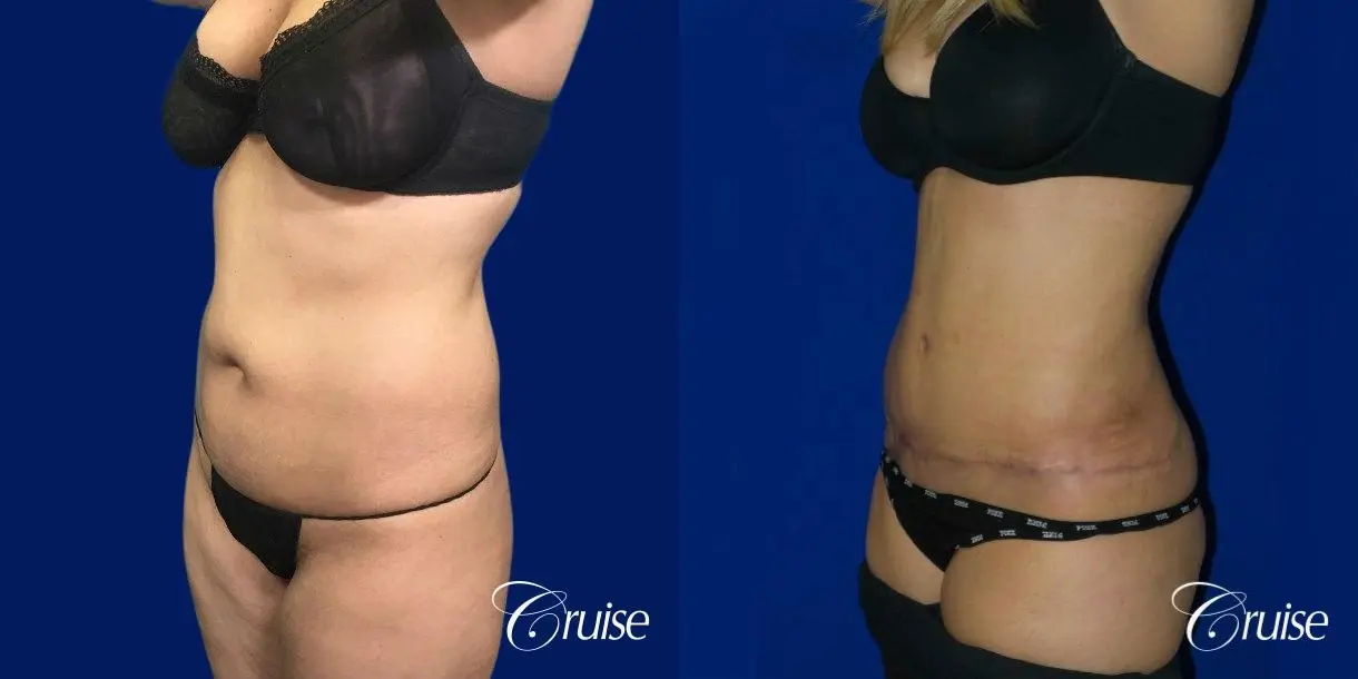 Tummy Tuck Standard Incision - Before and After 3