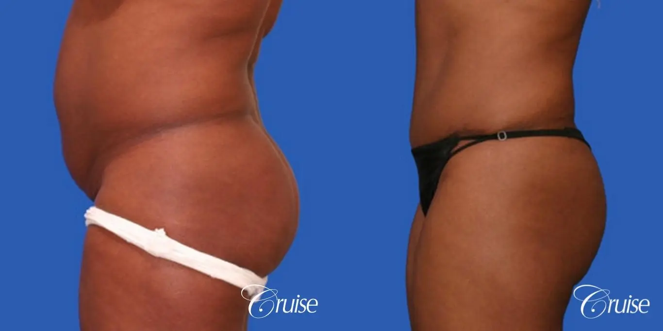best scar below bikini line on Tummy tuck - Before and After 2