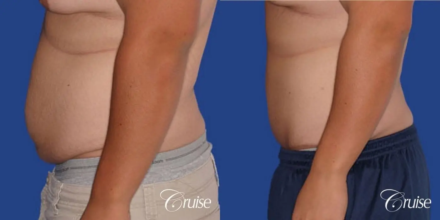 best before and after tummy tuck gallery male - Before and After 2